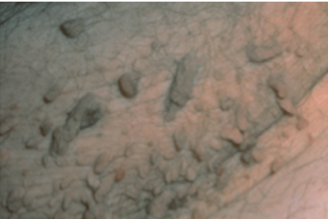 角化过度角化不全炎症