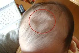 娃头顶的“菱形缝隙”，预示了娃的健康状态，6种变化宝妈要注意图片