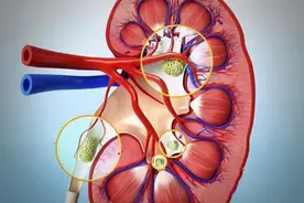肾结石“体外碎石”并非“万能”，它的这些副作用你知道吗？图片