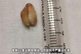 健康丨67岁老人咳嗽9年不愈只因一粒花生米图片