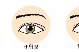 想做双眼皮手术？有些不是永久性的哦图片