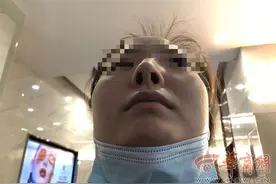 西安女子花近5万隆鼻，做了三次手术后都是歪的，自称嗅觉也不灵了图片