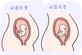 胎盘前壁和胎盘后壁有何区别？除胎儿状态外，面临的风险也不相同图片