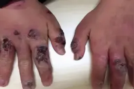 一个动作，十指溃烂！冬季宝宝最容易得这些皮肤病，别乱治图片