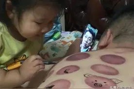 吉林一男子拔完火罐，女儿用笔给爸爸画“纹身”，满满的卡通风格图片
