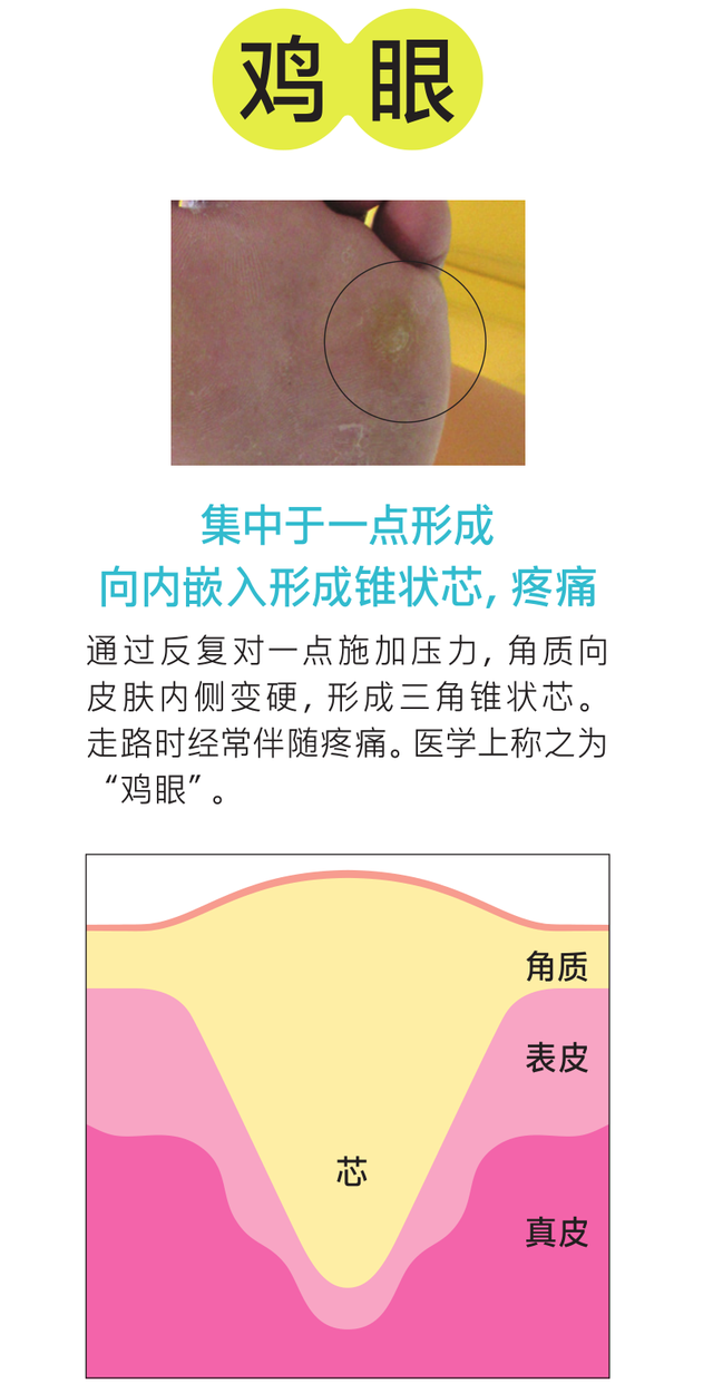 角化过度型足癣脂肪肝