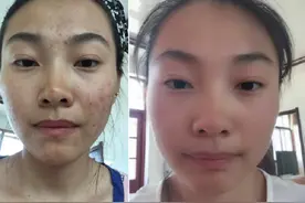 脸上长痘不要慌，3个常见原因带你对号入座！图片