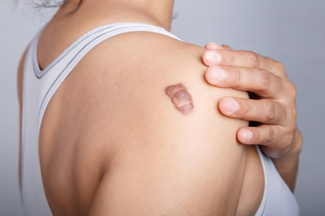 疤痕凸起是什么原因?是疤痕增生吗?