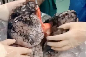 30年烟龄者的肺，你见过吗？戒烟后，肺还能“救”回来吗？图片