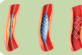 支架手术后如何才能活得更久？医生支招关键靠这3点，建议收藏图片