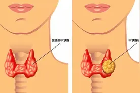 检查出自己有甲状腺结节？！三甲医院外科医生手把手教你看懂甲状腺彩超报告结果！图片