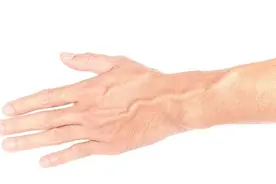 辟谣！手上的青筋凸起代表体质差？让专家告诉你答案图片