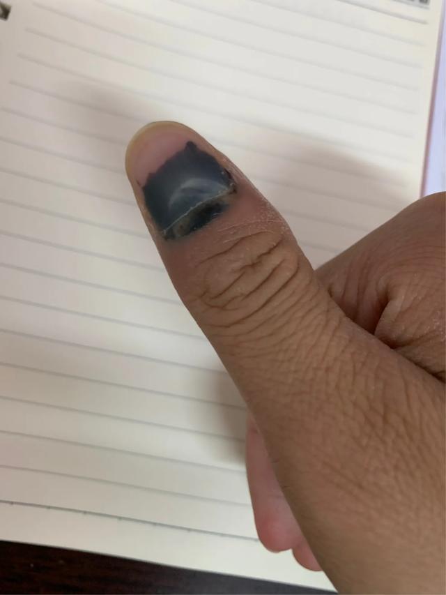 指甲盖被砸了有瘀血怎么办