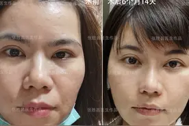 做完脂肪填充，面部夸张、僵硬不自然？医生说：做到这几点可避免图片