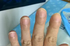 体内有病，手指先知？手指出现4种特征，要排除疾病或癌的可能图片