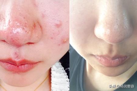 科普:什么是酒渣鼻?不看不知道,一看吓一跳