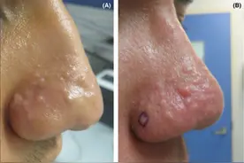 痤疮后鼻丘疹，你可能错误诊断为酒糟鼻图片