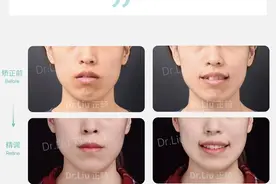 厦门牙齿矫正｜隐适美正畸｜个别牙反颌+开唇露齿图片