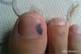 指甲变黑了是身体出了问题吗，黑指甲是否有癌变的可能？图片