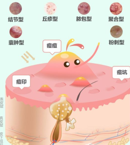 丘疹性痤疮怎么治(如何治疗丘疹性痘痘ps姐姐告诉你) - 创业分享 - 九