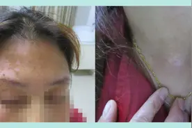 涂漆厂女工患上白癜风，身体过度劳累发出警报图片