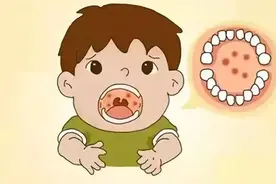 【中西合璧健康谈】六大措施，应对小儿疱疹性咽峡炎图片