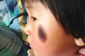 胎记"与生俱来"，管不住嘴又迈不开腿，宝妈难辞其咎图片
