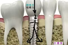为什么我的牙齿状况种牙最好？烤瓷牙和种植牙这样选！图片