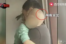 又见“大头娃娃”！多名婴儿营养不良被诊断为佝偻病，母婴店将饮料当奶粉推销，店长：我是跟着销售走图片