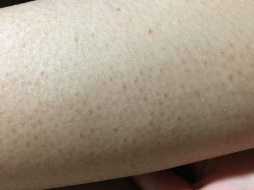 女生身上鸡皮肤好吗