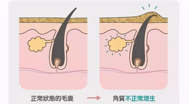 胳膊上有一小块干燥起皮类似鸡皮疙瘩