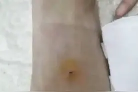8岁女孩被同班男同学铅笔戳脚背，险些致残！学生家长透露更多恐怖细节图片