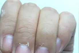 孩子指甲周围不断起皮长倒刺？教你2招轻松搞定，明白人一看就会视频封面