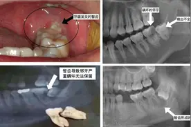看牙避坑指南：拔智齿前纠结的那些事儿，一次性和你唠清楚图片