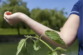 荨麻疹的祸根找到了，提醒：7类食物要注意忌口，以免病情反复图片