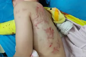 触目惊心！4岁女童在小区被狗咬得遍体鳞伤，狗主人至今未出现图片