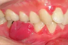 牙龈上突然长了肿瘤？别害怕，这没你想象中那么严重图片