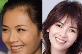 90%的明星做了烤瓷牙？我也想做：做之前，请一字不漏看完图片