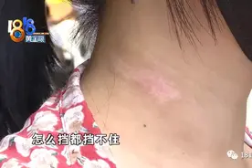 姑娘拔火罐，后背起了火图片