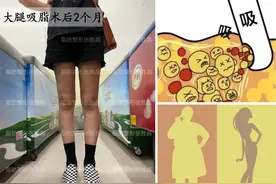 作为“做过吸脂”的过来人，告诉姐妹们其中的5个真相图片