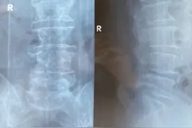 这么简单的骨折，医生为什么要打那么多钉子？图片