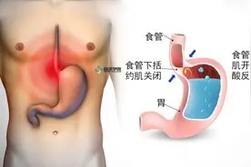 【豫健科普】连院士都曾6次被误诊，胃食管反流病是咋回事儿？图片