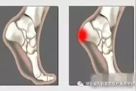 跟腱炎是怎么回事？还能不能好好跑步了？图片