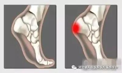 跟腱周围炎（跟腱炎是怎么回事还能不能好好跑步了）