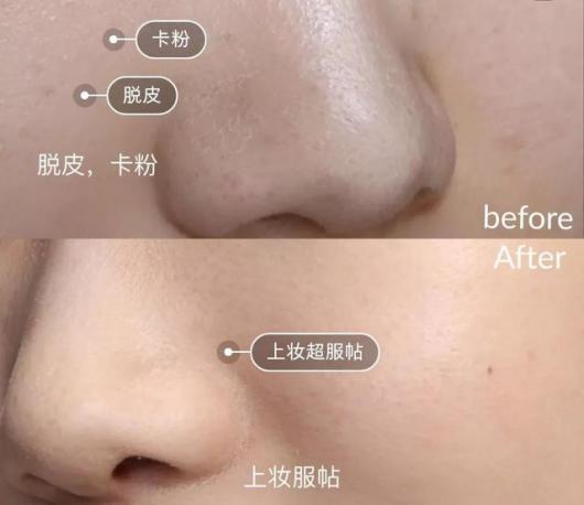 去粉刺毛囊炎痤疮鸡皮身体乳