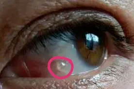 眼白长“鱼泡泡”怎么办？（如图）图片