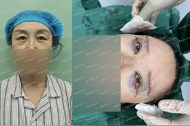 一台眼周年轻化手术，真的可以改变一个人图片