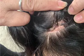 头顶留疤！“湛江杀人案”被砍女子发声：27年前刀下捡命，最想讨一个公道图片