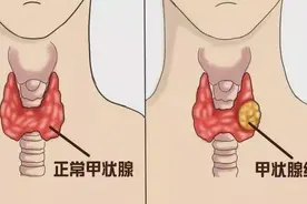 嗓子哑以为是上火？其实是甲状腺癌，已成深圳女性新“癌王”图片