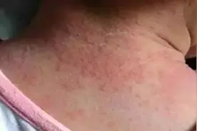 爽身粉致癌后，又查出铅超标！比起湿疹和痱子，娃更怕这些水和粉图片